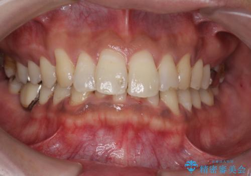 タバコによるヤニ、着色、歯の汚れをPMTC(60分コース)で除去。の治療後
