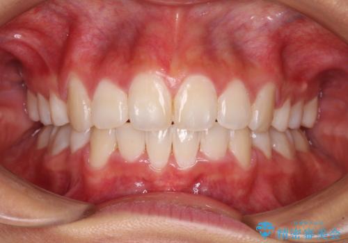 口元の突出感を改善　2年弱での抜歯矯正の治療後