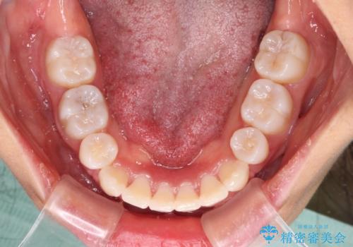口元の突出感を改善　2年弱での抜歯矯正の治療後