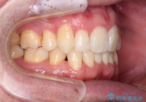 ものが挟まる　著しい叢生を解消　ワイヤー装置による抜歯矯正の治療後