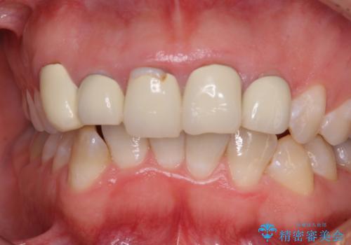 不揃いな前歯のセラミックが気になる　オールセラミッククラウンによる補綴治療の治療前