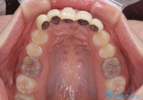不揃いな前歯のセラミックが気になる　オールセラミッククラウンによる補綴治療の治療前