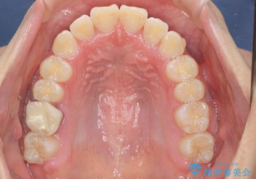 [インビザライン]  前歯のガタつき・すれ違い　マウスピース矯正治療の治療後
