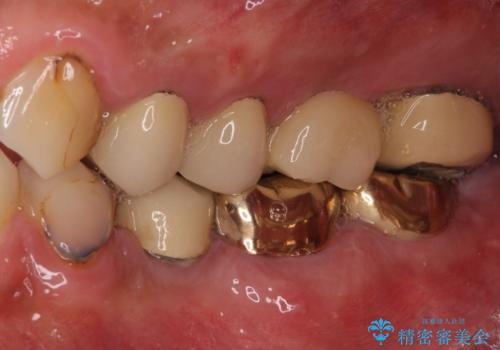抜歯が必要な左右の奥歯　ブリッジとインプラントによる奥歯の補綴治療の治療前