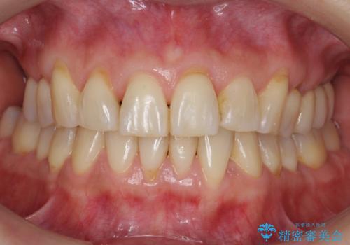 前歯が反対になっている　マウスピース矯正+奥歯ブリッジの治療後