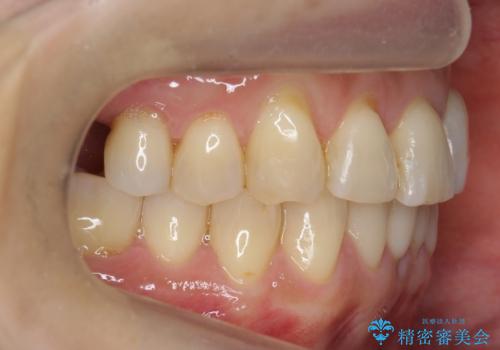 前歯が反対になっている　マウスピース矯正+奥歯ブリッジの治療後