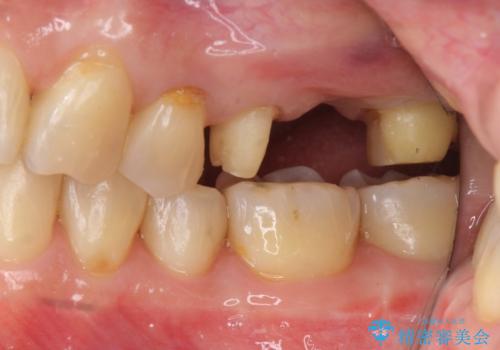 前歯が反対になっている　マウスピース矯正+奥歯ブリッジの治療中