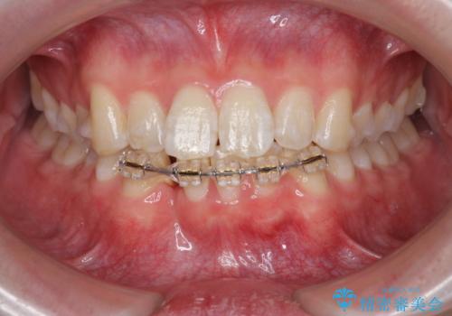 [ Three-incisor ]  歯肉退縮した歯を抜去しマウスピース治療で改善の治療中