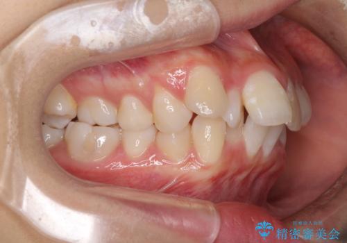 口元の突出感を改善　2年弱での抜歯矯正の治療前