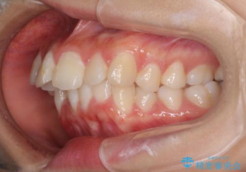 口元の突出感を改善　2年弱での抜歯矯正の治療前