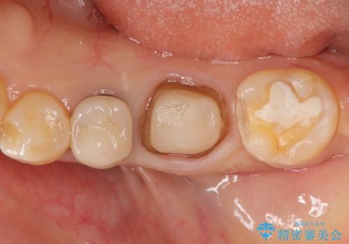 [ 歯牙破折 ]  違和感のある大臼歯 ブリッジ治療の治療前