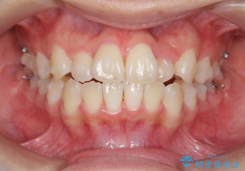 [インビザライン]  前歯のガタつき・すれ違い　マウスピース矯正治療の治療中