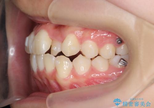[インビザライン]  前歯のガタつき・すれ違い　マウスピース矯正治療の治療中