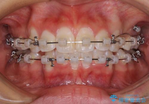 口元の突出感を改善　2年弱での抜歯矯正の治療中