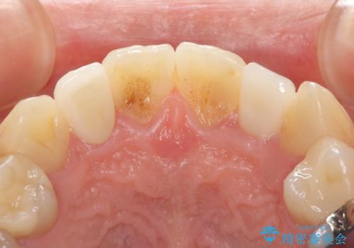 歯の外部吸収　難しい根の治療　30代男性の治療後