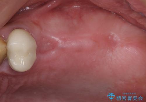 抜歯が必要な左右の奥歯　ブリッジとインプラントによる奥歯の補綴治療の治療中