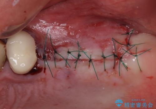 抜歯が必要な左右の奥歯　ブリッジとインプラントによる奥歯の補綴治療の治療後