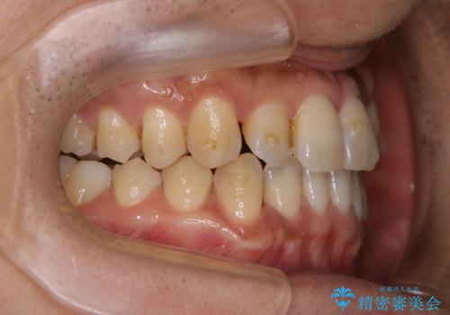 マウスピース矯正の途中にPMTCで白い歯にの治療前