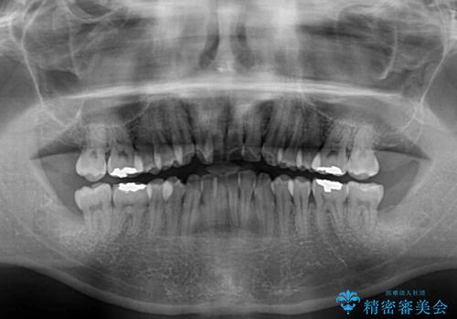下顎骨が顕著に右側にずれている　インビザラインによる咬合改善の治療前