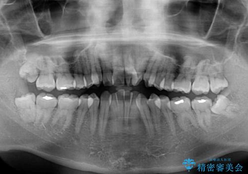 ものが挟まる　著しい叢生を解消　ワイヤー装置による抜歯矯正の治療前