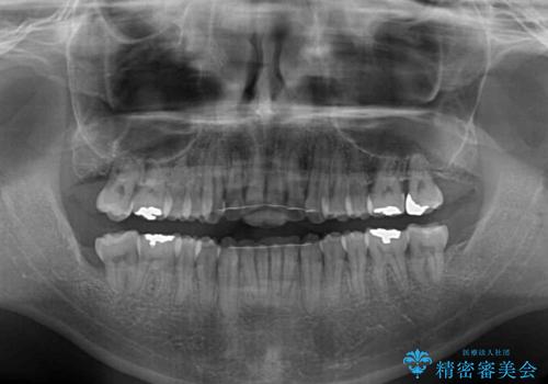 下顎骨が顕著に右側にずれている　インビザラインによる咬合改善の治療後
