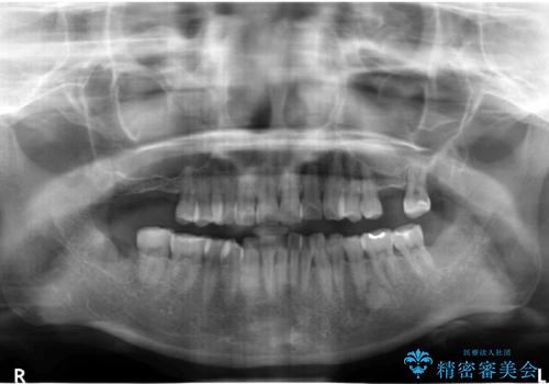 前歯が反対になっている　マウスピース矯正+奥歯ブリッジの治療前
