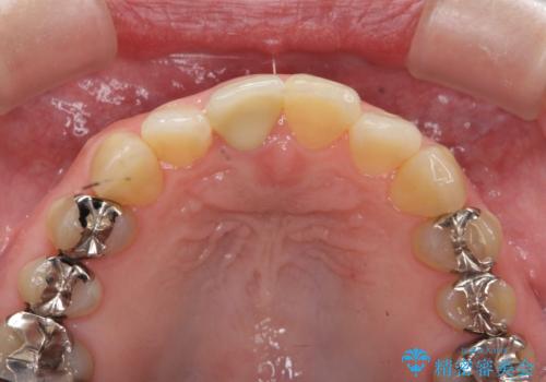 セラミッククラウン　歯ぐきの黒ずみの改善の治療後