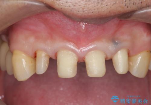 「 放置した虫歯 」 前歯セラミック治療　の治療中