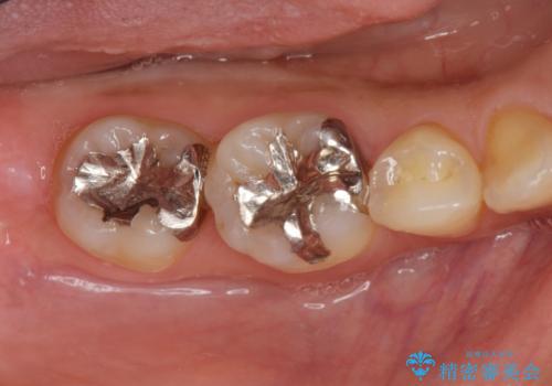 銀歯を白く　セラミックインレー治療の治療前