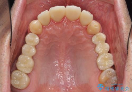 インプラント治療・セラミック治療を含む  全顎的虫歯治療の治療後