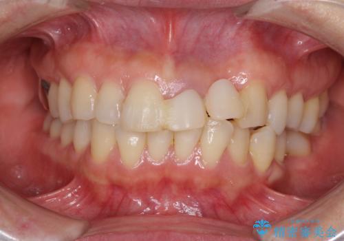 口元の突出感を治したい　治療中の歯も治したいの症例 治療前