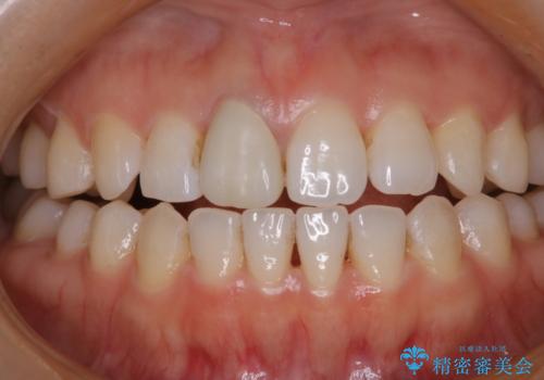 歯と歯の間の色が気になる　1日で綺麗に落とすの治療前