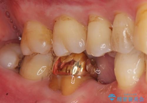 親知らずのせいで隣の歯が虫歯に　40代男性の症例 治療前