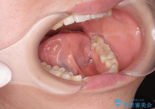 [ 舌小帯の形成 ]滑舌を改善したいの症例 治療前