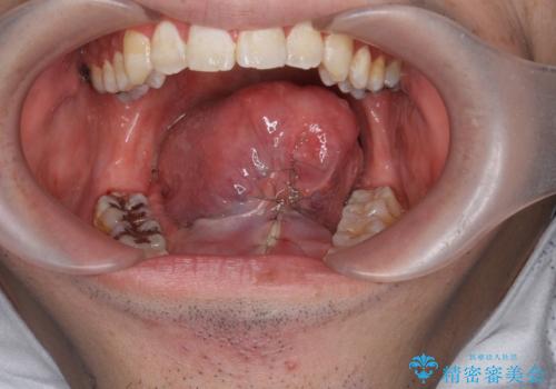 舌小帯・上唇小帯切除の症例 治療後