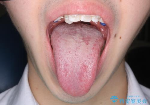 滑舌が気になる:矯正治療前に舌小帯切除の症例 治療後