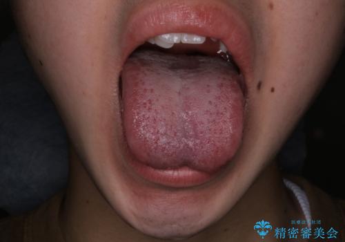 滑舌が気になる:矯正治療前に舌小帯切除の症例 治療前