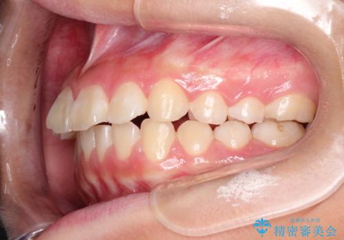インビザラインによる出っ歯の非抜歯矯正の症例 治療前