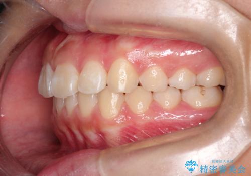 インビザラインによる出っ歯の非抜歯矯正の症例 治療後