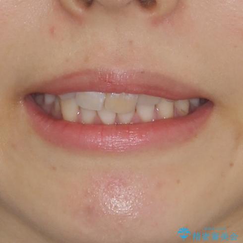 内側にある歯が邪魔　重なった前歯の歯列矯正の治療前（顔貌）