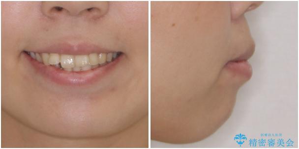 前歯の出っ歯と口の閉じにくさを抜歯矯正で改善　目立たないワイヤー矯正の治療前（顔貌）