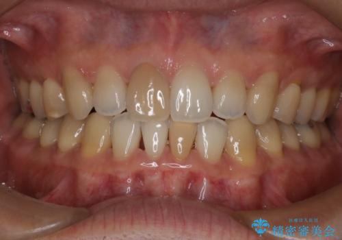 【前歯の隙間】インビザラインですきっ歯の矯正治療の治療後