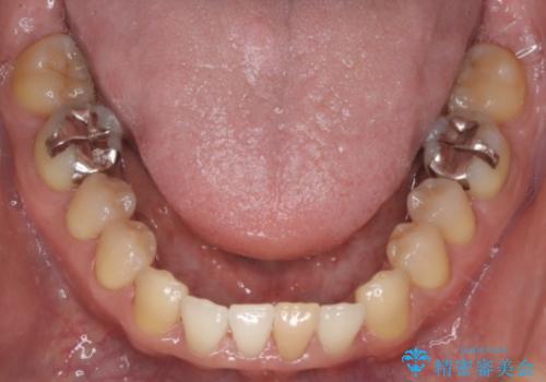 【前歯の隙間】インビザラインですきっ歯の矯正治療の治療後
