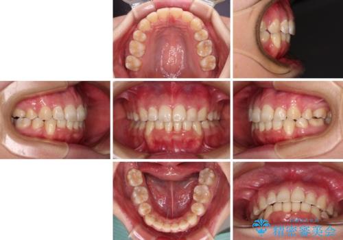 前歯の出っ歯と口の閉じにくさを抜歯矯正で改善　目立たないワイヤー矯正の治療後