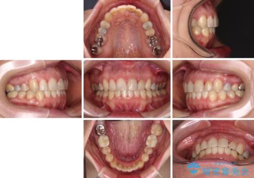 【モニター】前歯のデコボコと奥歯の虫歯　インビザライン治療と奥歯のセラミック治療の治療後
