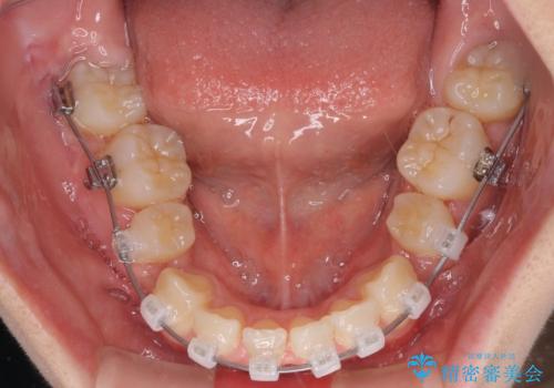 前歯の歯並びを治したい　ワイヤー装置での抜歯矯正の治療中
