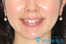 矮小歯を綺麗な歯に。矯正とセラミックの総合治療の治療前（顔貌）