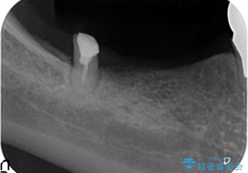 薄い骨幅　骨造成　歯肉移植を併用したインプラント治療の治療前