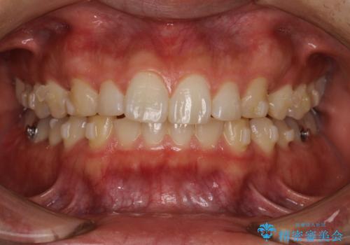 出っ歯が気になる　インビザラインによる出っ歯の目立たない矯正の治療中