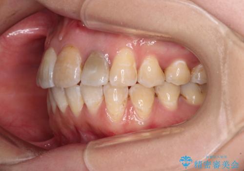 内側にある歯が邪魔　重なった前歯の歯列矯正の治療後